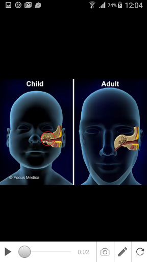 Otitis Media Screen 3