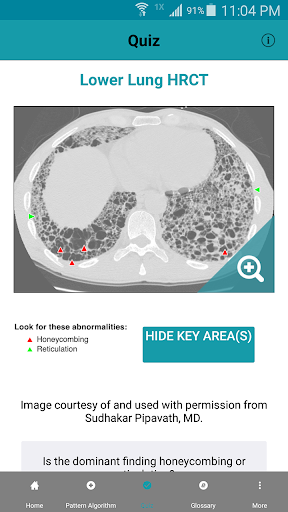 Rad Rounds - UIP to IPF Screen 3