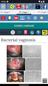 Bacterial vaginosis Treatment