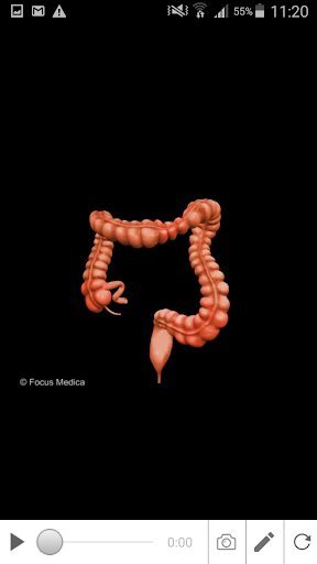 Inflammatory Bowel Disease Screen 3