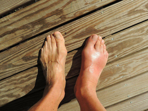 Home Remedies For Gout Screen 2