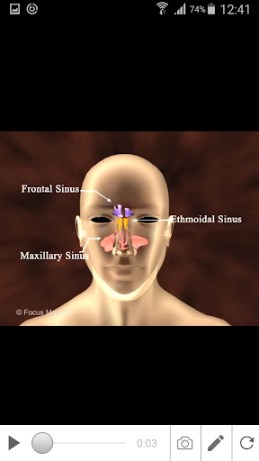 Sinusitis