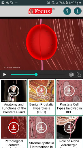 Animated Atlas of BPH Screen 3