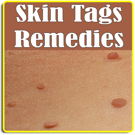 Skin tags & Remedies To Remove logo