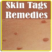 Skin tags Treatment and Home Remedies To Remove