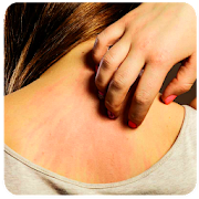How to Get Rid of a Rash