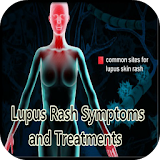 Lupus Rash Symptoms Treatments icon