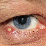 Eye Infection Ka Ilaj icon