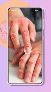Psoriasis is curable