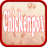 Chickenpox Disease icon