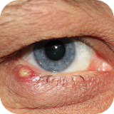 العلاجات المنزلية العين عدوى icon