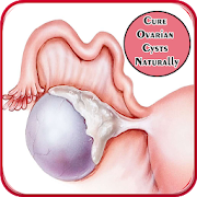 Cure Ovarian Cysts Naturally