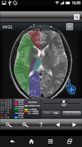 断面図ウォーカー脳MRI