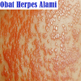 Obat Herpes Alami icon