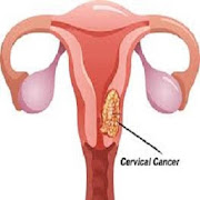 Cervical Cancer