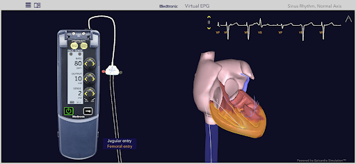 Medtronic VirtualEPG Screen 3