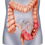 Cover Image of Baixar All about Colon Cancer  APK