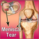 Meniscal Tear icon