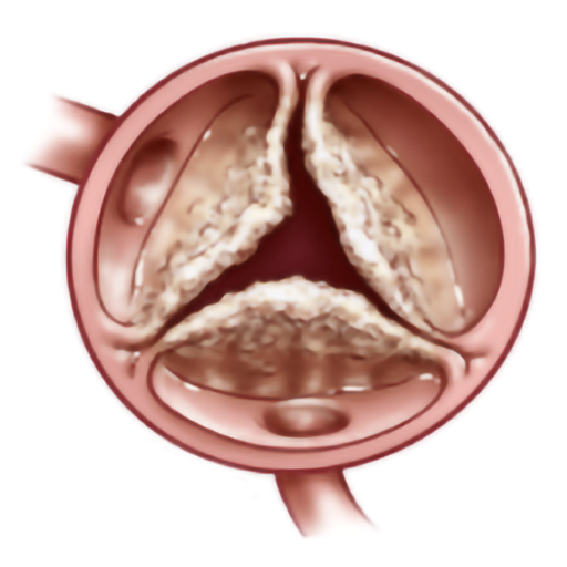 Aortic Stenosis [UHB] logo