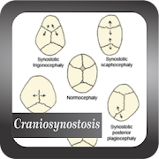 Recognize Craniosynostosis Disease
