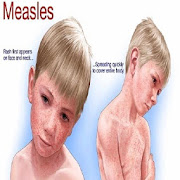 Measles Disease & Treatment