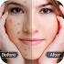 Face Blemish Remover - Smooth1.7
