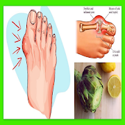 Home remedies uric acid gout