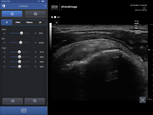 SONON Ultrasound App Screen 2