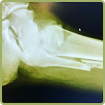 Cover Image of Tải xuống Fracture  APK