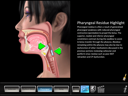Swallowing Residue Screen 2