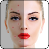 Acne Free : Pimple Remover icon