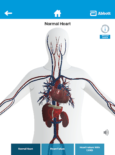 LVAD by Abbott Screen 2