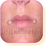 How to treat Angular Cheilitis at Home Naturally icon