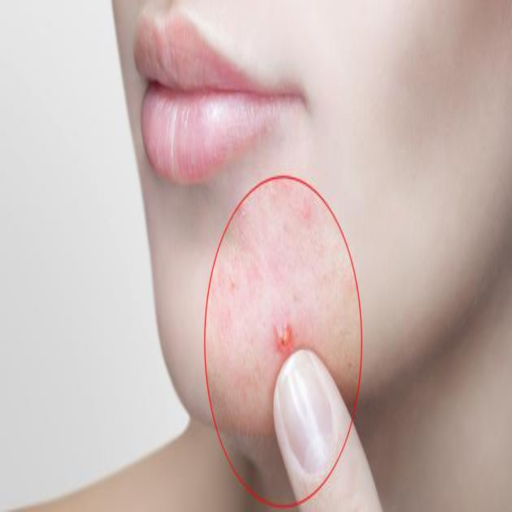 Facial acne treatment logo
