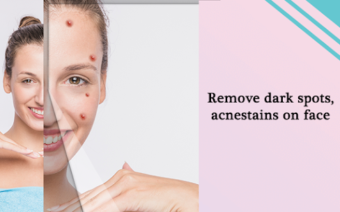 Pimple Remover, Eraser – Face Beauty Maker 1