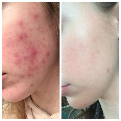 Treat acne naturally at home logo