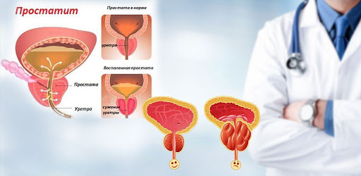Learn how to get rid of prosta