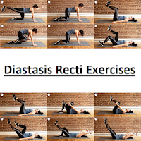 Diastasis Recti Exercises