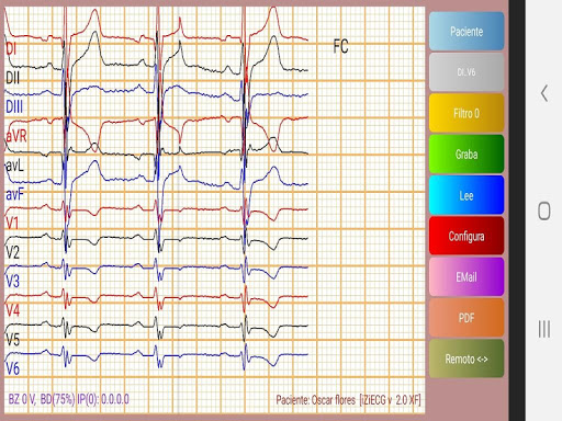 ZiECG Electrocardiografía Screen 2
