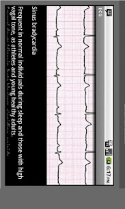 Electrocardiogram ECG Types For PC installation