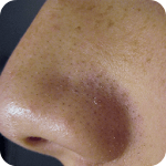 Cover Image of Download Remove Blackheads Home Remedy 1.3 APK
