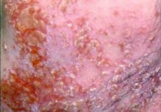 Skin infections guideのおすすめ画像2
