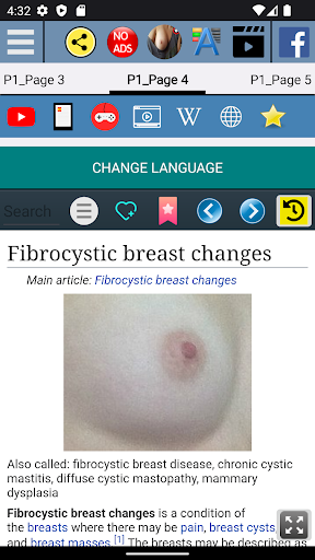 Breast disease