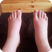 Swelling Feet Home Remedies
