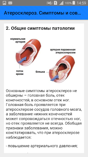 Атеросклероз. Симптомы и совет Screenshot 3 - AppWisp.com