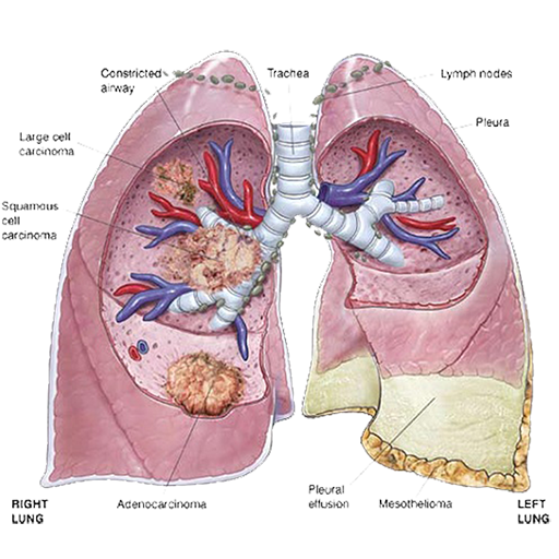 does agent orange cause liver cancer